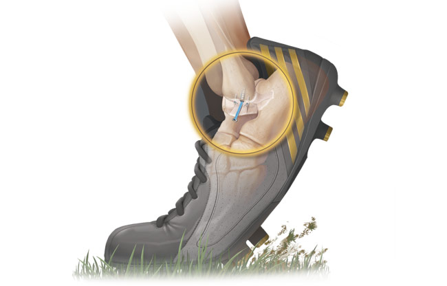 InternalBrace Ligament Augmentation Repair System